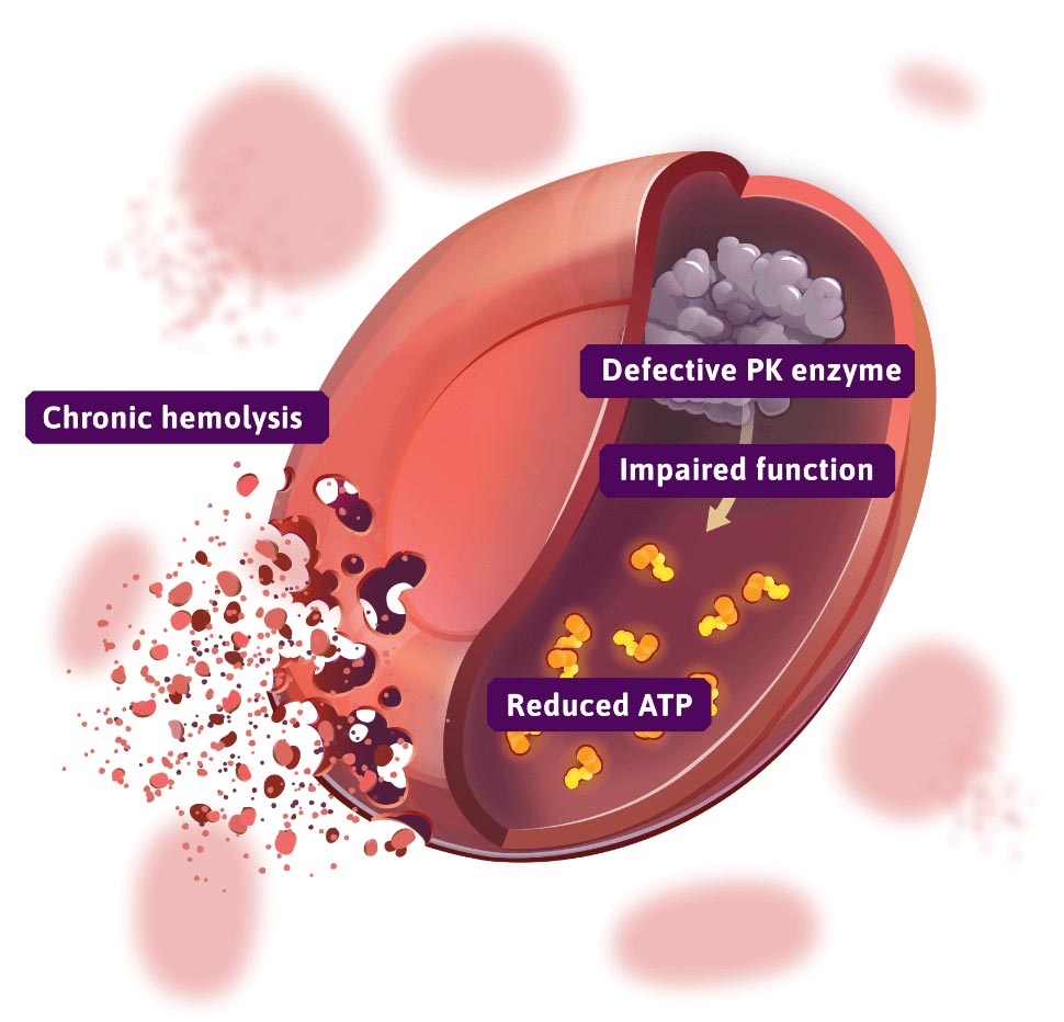red blood cell affected by pyruvate kinase deficiency