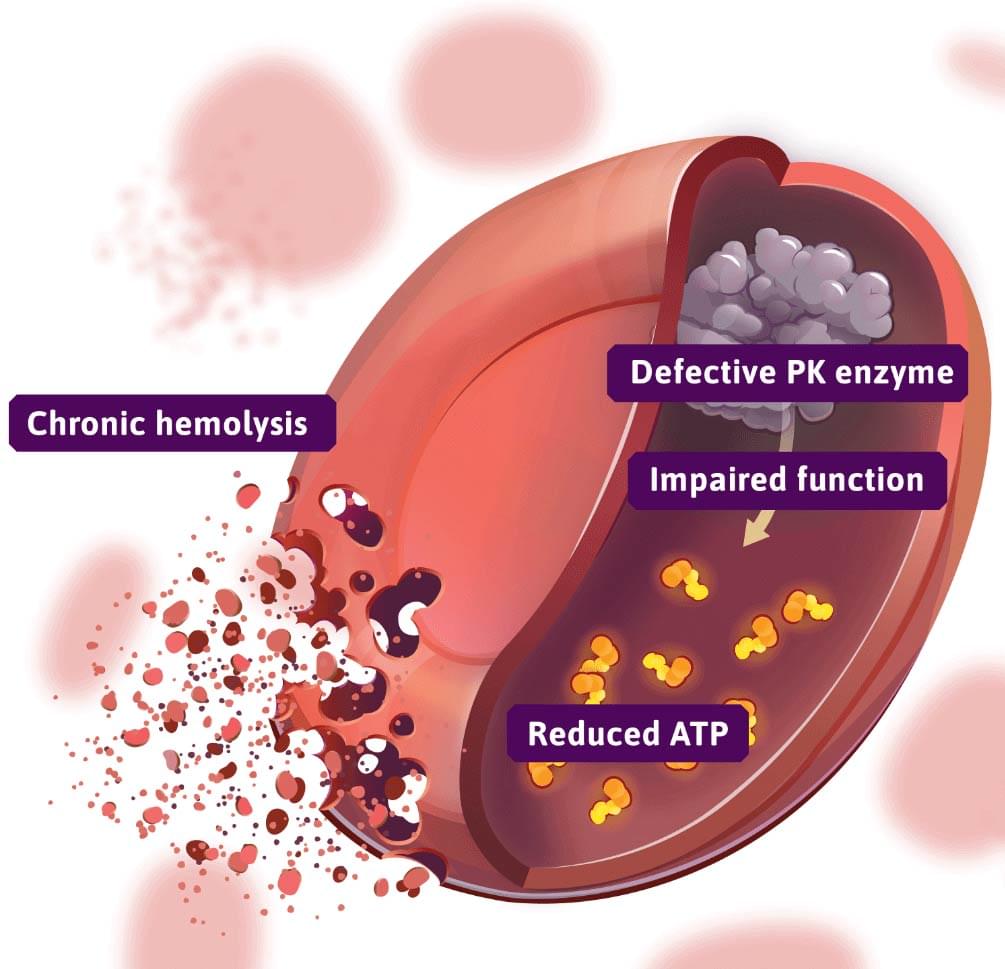 red blood cell affected by pyruvate kinase deficiency